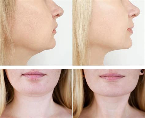 belkyra ervaringen|What is Belkyra Treatment .